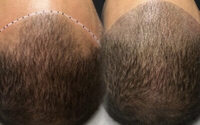 Regaining Confidence: The Comprehensive Guide to Using Scalp Micropigmentation for Hair Loss Solutions